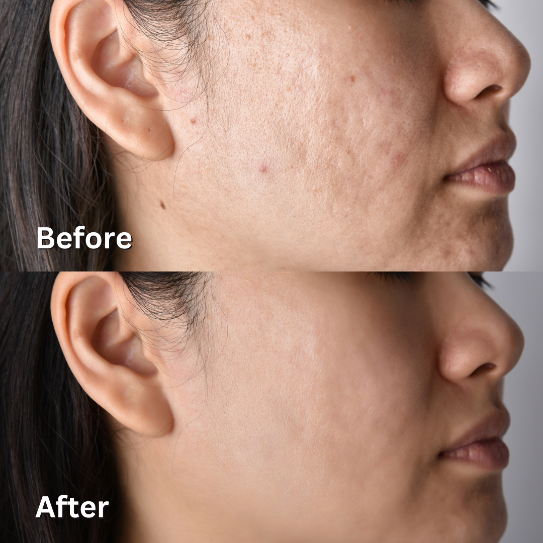 Acne Cure Soap